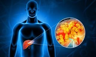 早期肝硬化能活几年 早期肝硬化能活几年